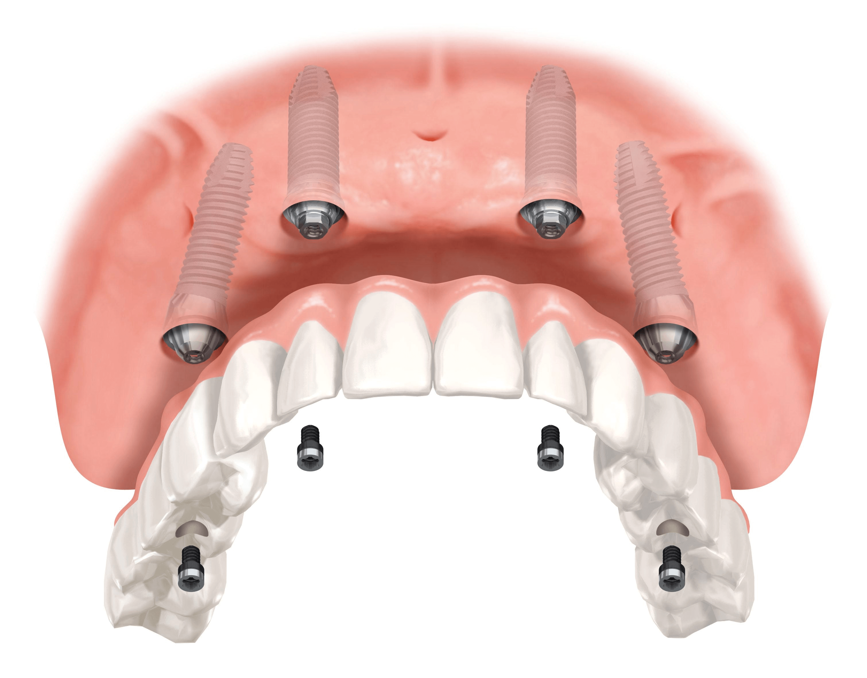 SFP Dental Service: Implantologia all on four a Brescia